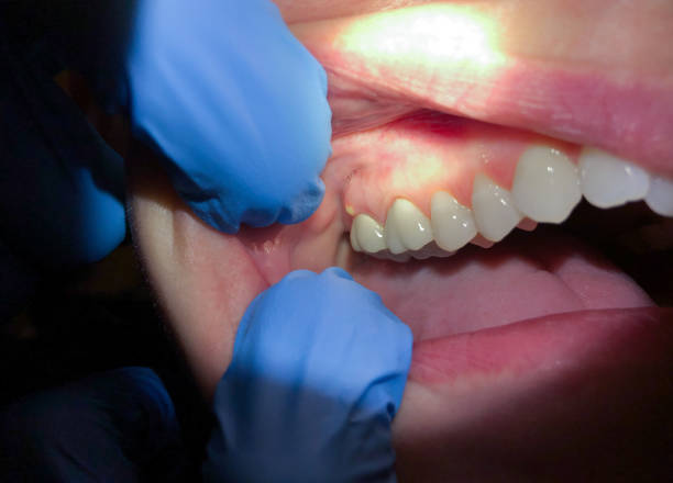 Best Dentist for Tooth Abscess  in Marine, IL